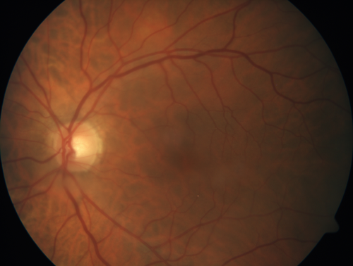 Subtle Branch Retinal Artery Occlusion
68 year old man with shadow in the left eye yesterday.  IR and OCT show subtle retinal swelling.  FA is normal
