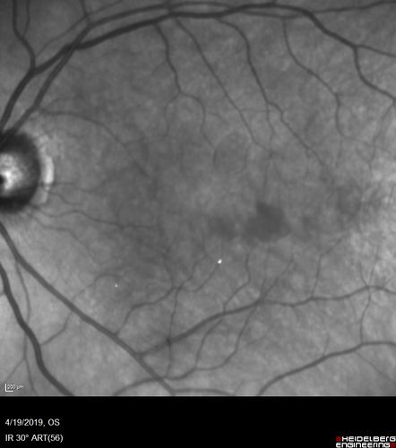 Subtle Branch Retinal Artery Occlusion
68 year old man with shadow in the left eye yesterday.  IR and OCT show subtle retinal swelling.  FA is normal
