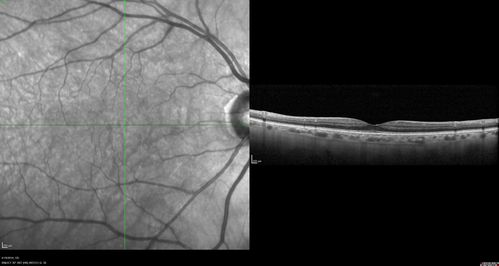 Subtle Branch Retinal Artery Occlusion
68 year old man with shadow in the left eye yesterday.  IR and OCT show subtle retinal swelling.  FA is normal
