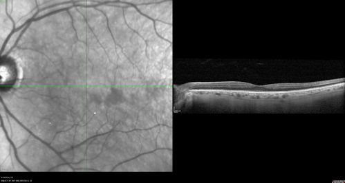 Subtle Branch Retinal Artery Occlusion
68 year old man with shadow in the left eye yesterday.  IR and OCT show subtle retinal swelling.  FA is normal
