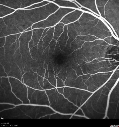 Subtle Branch Retinal Artery Occlusion
68 year old man with shadow in the left eye yesterday.  IR and OCT show subtle retinal swelling.  FA is normal
