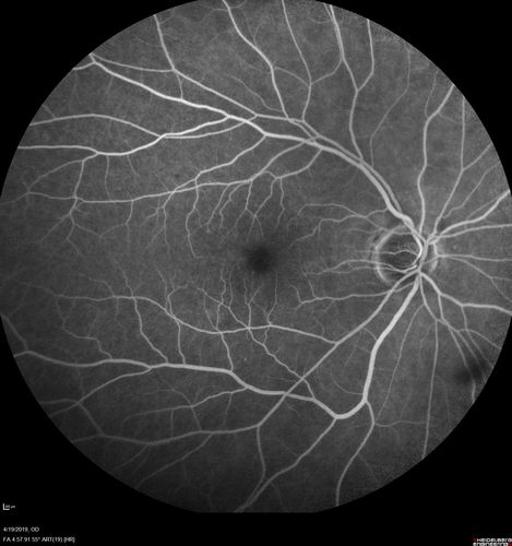 Subtle Branch Retinal Artery Occlusion
68 year old man with shadow in the left eye yesterday.  IR and OCT show subtle retinal swelling.  FA is normal
