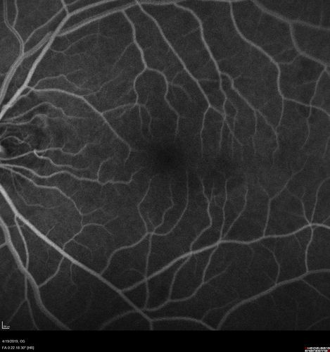 Subtle Branch Retinal Artery Occlusion
68 year old man with shadow in the left eye yesterday.  IR and OCT show subtle retinal swelling.  FA is normal
