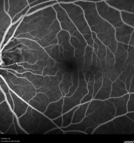 Subtle Branch Retinal Artery Occlusion
68 year old man with shadow in the left eye yesterday.  IR and OCT show subtle retinal swelling.  FA is normal
