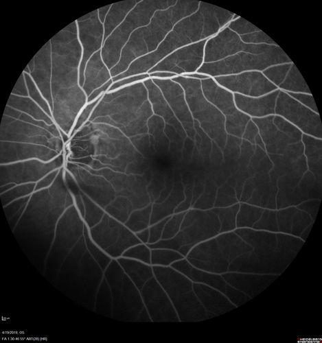 Subtle Branch Retinal Artery Occlusion
68 year old man with shadow in the left eye yesterday.  IR and OCT show subtle retinal swelling.  FA is normal

