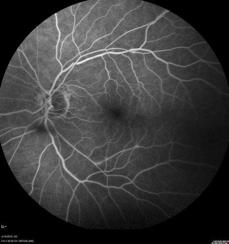 Subtle Branch Retinal Artery Occlusion
68 year old man with shadow in the left eye yesterday.  IR and OCT show subtle retinal swelling.  FA is normal
