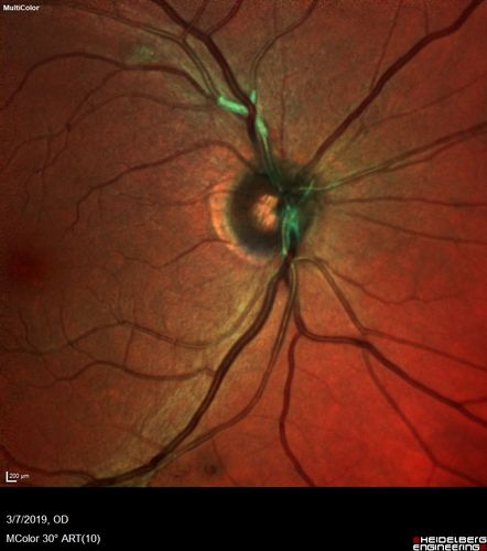 Branch Retinal Vein Occlusion with Edema - Failed avastin (bevacizumab) and did well with Eylea (Aflibercept)
67 year old female The vision in the left eye was good until about 4 months ago.Â  Prior to that it was OK.Â  The vision in the right eye is fine.Â  She is not sure if she has had strokes from studies taken in December.Â  She was, at that time, sent to the ER for high blood pressure.Â Â 
VA OD: Dcc20/40 OS: 20/100
Four treatments with Avastin she was still 20/100 with edema.  With two Eylea treatments she improved to 20/32 and has remained dry and with good vision
