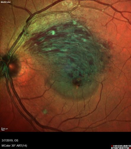 Branch Retinal Vein Occlusion with Edema - Failed avastin (bevacizumab) and did well with Eylea (Aflibercept)
67 year old female The vision in the left eye was good until about 4 months ago.Â  Prior to that it was OK.Â  The vision in the right eye is fine.Â  She is not sure if she has had strokes from studies taken in December.Â  She was, at that time, sent to the ER for high blood pressure.Â Â 
VA OD: Dcc20/40 OS: 20/100
Four treatments with Avastin she was still 20/100 with edema.  With two Eylea treatments she improved to 20/32 and has remained dry and with good vision
