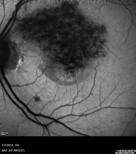 Branch Retinal Vein Occlusion with Edema - Failed avastin (bevacizumab) and did well with Eylea (Aflibercept)
67 year old female The vision in the left eye was good until about 4 months ago.Â  Prior to that it was OK.Â  The vision in the right eye is fine.Â  She is not sure if she has had strokes from studies taken in December.Â  She was, at that time, sent to the ER for high blood pressure.Â Â 
VA OD: Dcc20/40 OS: 20/100
Four treatments with Avastin she was still 20/100 with edema.  With two Eylea treatments she improved to 20/32 and has remained dry and with good vision
