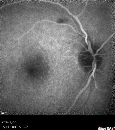 Branch Retinal Vein Occlusion with Edema - Failed avastin (bevacizumab) and did well with Eylea (Aflibercept)
67 year old female The vision in the left eye was good until about 4 months ago.Â  Prior to that it was OK.Â  The vision in the right eye is fine.Â  She is not sure if she has had strokes from studies taken in December.Â  She was, at that time, sent to the ER for high blood pressure.Â Â 
VA OD: Dcc20/40 OS: 20/100
Four treatments with Avastin she was still 20/100 with edema.  With two Eylea treatments she improved to 20/32 and has remained dry and with good vision
