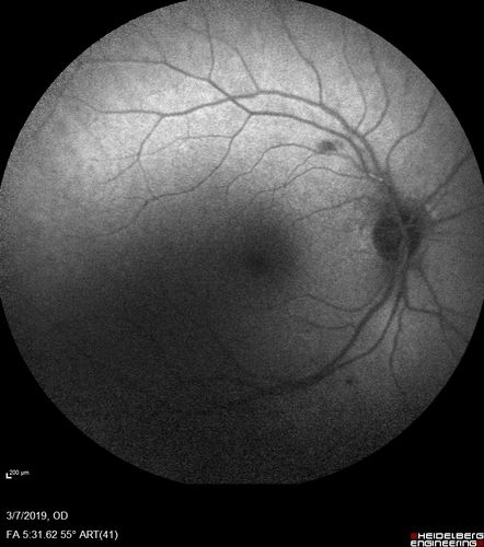 Branch Retinal Vein Occlusion with Edema - Failed avastin (bevacizumab) and did well with Eylea (Aflibercept)
67 year old female The vision in the left eye was good until about 4 months ago.Â  Prior to that it was OK.Â  The vision in the right eye is fine.Â  She is not sure if she has had strokes from studies taken in December.Â  She was, at that time, sent to the ER for high blood pressure.Â Â 
VA OD: Dcc20/40 OS: 20/100
Four treatments with Avastin she was still 20/100 with edema.  With two Eylea treatments she improved to 20/32 and has remained dry and with good vision

