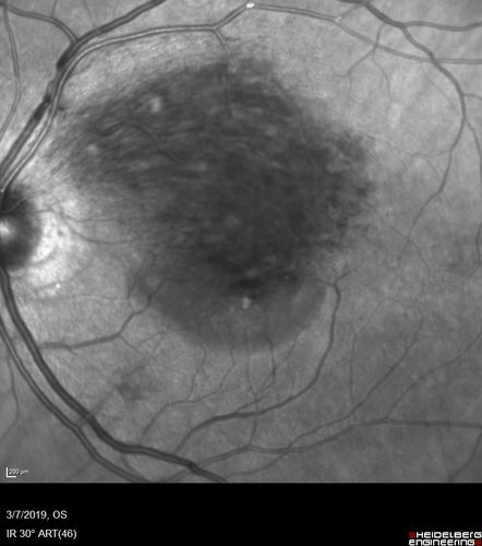 Branch Retinal Vein Occlusion with Edema - Failed avastin (bevacizumab) and did well with Eylea (Aflibercept)
67 year old female The vision in the left eye was good until about 4 months ago.Â  Prior to that it was OK.Â  The vision in the right eye is fine.Â  She is not sure if she has had strokes from studies taken in December.Â  She was, at that time, sent to the ER for high blood pressure.Â Â 
VA OD: Dcc20/40 OS: 20/100
Four treatments with Avastin she was still 20/100 with edema.  With two Eylea treatments she improved to 20/32 and has remained dry and with good vision
