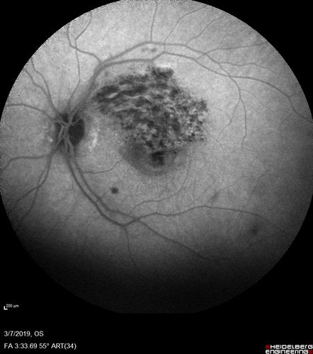 Branch Retinal Vein Occlusion with Edema - Failed avastin (bevacizumab) and did well with Eylea (Aflibercept)
67 year old female The vision in the left eye was good until about 4 months ago.Â  Prior to that it was OK.Â  The vision in the right eye is fine.Â  She is not sure if she has had strokes from studies taken in December.Â  She was, at that time, sent to the ER for high blood pressure.Â Â 
VA OD: Dcc20/40 OS: 20/100
Four treatments with Avastin she was still 20/100 with edema.  With two Eylea treatments she improved to 20/32 and has remained dry and with good vision
