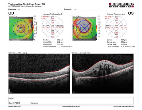 Branch Retinal Vein Occlusion with Edema - Failed avastin (bevacizumab) and did well with Eylea (Aflibercept)
67 year old female The vision in the left eye was good until about 4 months ago.Â  Prior to that it was OK.Â  The vision in the right eye is fine.Â  She is not sure if she has had strokes from studies taken in December.Â  She was, at that time, sent to the ER for high blood pressure.Â Â 
VA OD: Dcc20/40 OS: 20/100
Four treatments with Avastin she was still 20/100 with edema.  With two Eylea treatments she improved to 20/32 and has remained dry and with good vision

