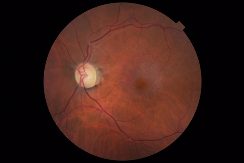 Vascular Remodeling Bilateral BRVO
85 year old female 20/25 OU with BRVO 7 years ago in both eyes.  She has a change in vision.  The FA shows extensive collaterallization and vascular remodeling in each macula.
