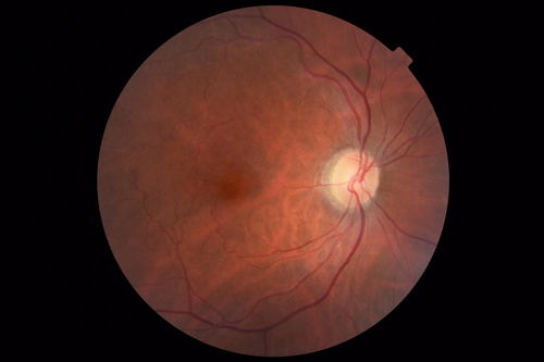 Vascular Remodeling Bilateral BRVO
85 year old female 20/25 OU with BRVO 7 years ago in both eyes.  She has a change in vision.  The FA shows extensive collaterallization and vascular remodeling in each macula.
