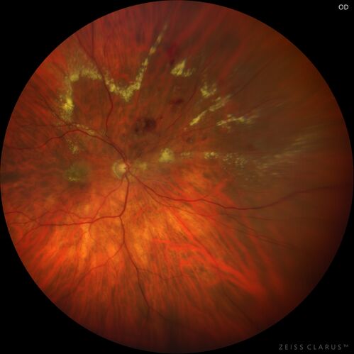 Branch Retinal Vein Occlusion with Venous Macroaneurysm (collateral)
66 year old female Did not notice vision loss in the right eye.  The right eye has been a little worse than the left but now is much worse.  Picked up during annual eye examination.  VA had been 20/20 in 5 years ago.
History of brain and spinal cord radiation 1986 for T-cell lymphoma.  Now with breast cancer, ablation for tachycardia, HTN
VA OD 6/200, OS 20/32

