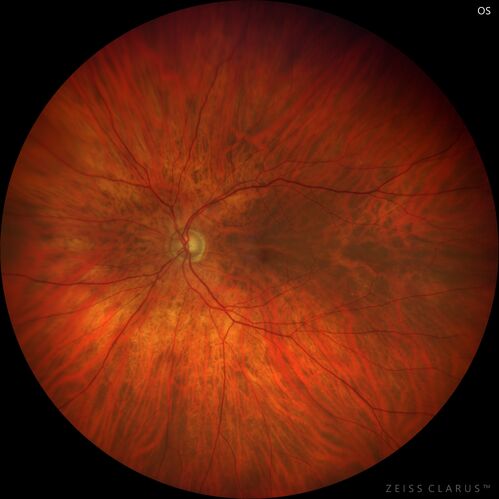 Branch Retinal Vein Occlusion with Venous Macroaneurysm (collateral)
66 year old female Did not notice vision loss in the right eye.  The right eye has been a little worse than the left but now is much worse.  Picked up during annual eye examination.  VA had been 20/20 in 5 years ago.
History of brain and spinal cord radiation 1986 for T-cell lymphoma.  Now with breast cancer, ablation for tachycardia, HTN
VA OD 6/200, OS 20/32
