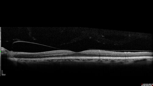 Branch Retinal Vein Occlusion with Venous Macroaneurysm (collateral)
66 year old female Did not notice vision loss in the right eye.  The right eye has been a little worse than the left but now is much worse.  Picked up during annual eye examination.  VA had been 20/20 in 5 years ago.
History of brain and spinal cord radiation 1986 for T-cell lymphoma.  Now with breast cancer, ablation for tachycardia, HTN
VA OD 6/200, OS 20/32

