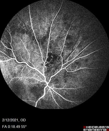 Branch Retinal Vein Occlusion with Venous Macroaneurysm (collateral)
66 year old female Did not notice vision loss in the right eye.  The right eye has been a little worse than the left but now is much worse.  Picked up during annual eye examination.  VA had been 20/20 in 5 years ago.
History of brain and spinal cord radiation 1986 for T-cell lymphoma.  Now with breast cancer, ablation for tachycardia, HTN
VA OD 6/200, OS 20/32
