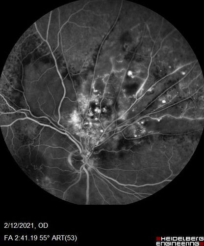 Branch Retinal Vein Occlusion with Venous Macroaneurysm (collateral)
66 year old female Did not notice vision loss in the right eye.  The right eye has been a little worse than the left but now is much worse.  Picked up during annual eye examination.  VA had been 20/20 in 5 years ago.
History of brain and spinal cord radiation 1986 for T-cell lymphoma.  Now with breast cancer, ablation for tachycardia, HTN
VA OD 6/200, OS 20/32
