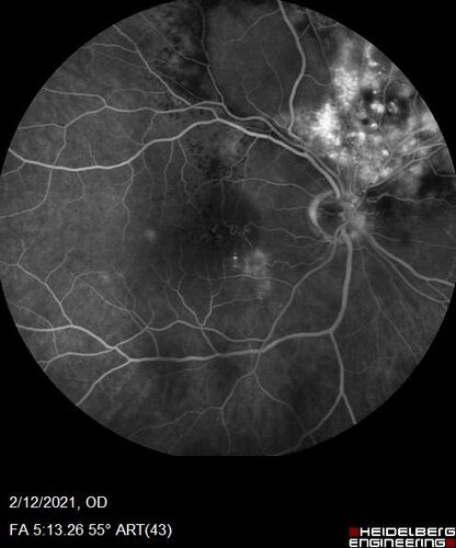 Branch Retinal Vein Occlusion with Venous Macroaneurysm (collateral)
66 year old female Did not notice vision loss in the right eye.  The right eye has been a little worse than the left but now is much worse.  Picked up during annual eye examination.  VA had been 20/20 in 5 years ago.
History of brain and spinal cord radiation 1986 for T-cell lymphoma.  Now with breast cancer, ablation for tachycardia, HTN
VA OD 6/200, OS 20/32
