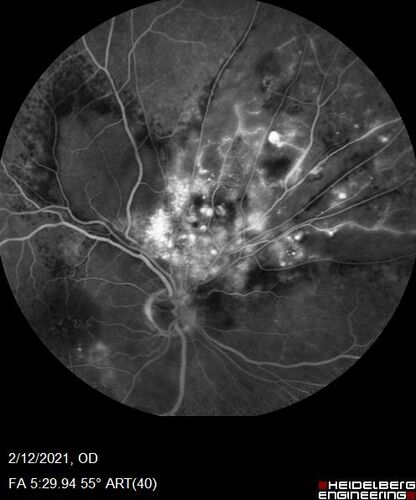 Branch Retinal Vein Occlusion with Venous Macroaneurysm (collateral)
66 year old female Did not notice vision loss in the right eye.  The right eye has been a little worse than the left but now is much worse.  Picked up during annual eye examination.  VA had been 20/20 in 5 years ago.
History of brain and spinal cord radiation 1986 for T-cell lymphoma.  Now with breast cancer, ablation for tachycardia, HTN
VA OD 6/200, OS 20/32
