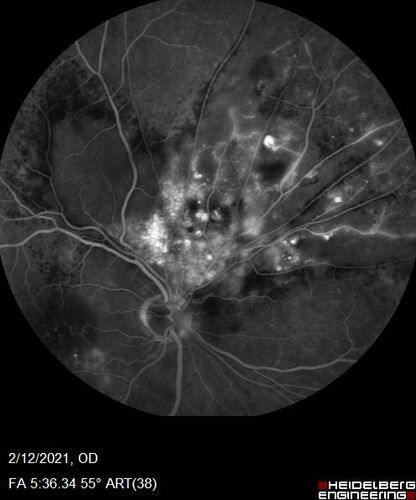 Branch Retinal Vein Occlusion with Venous Macroaneurysm (collateral)
66 year old female Did not notice vision loss in the right eye.  The right eye has been a little worse than the left but now is much worse.  Picked up during annual eye examination.  VA had been 20/20 in 5 years ago.
History of brain and spinal cord radiation 1986 for T-cell lymphoma.  Now with breast cancer, ablation for tachycardia, HTN
VA OD 6/200, OS 20/32
