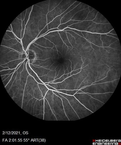 Branch Retinal Vein Occlusion with Venous Macroaneurysm (collateral)
66 year old female Did not notice vision loss in the right eye.  The right eye has been a little worse than the left but now is much worse.  Picked up during annual eye examination.  VA had been 20/20 in 5 years ago.
History of brain and spinal cord radiation 1986 for T-cell lymphoma.  Now with breast cancer, ablation for tachycardia, HTN
VA OD 6/200, OS 20/32
