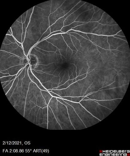 Branch Retinal Vein Occlusion with Venous Macroaneurysm (collateral)
66 year old female Did not notice vision loss in the right eye.  The right eye has been a little worse than the left but now is much worse.  Picked up during annual eye examination.  VA had been 20/20 in 5 years ago.
History of brain and spinal cord radiation 1986 for T-cell lymphoma.  Now with breast cancer, ablation for tachycardia, HTN
VA OD 6/200, OS 20/32
