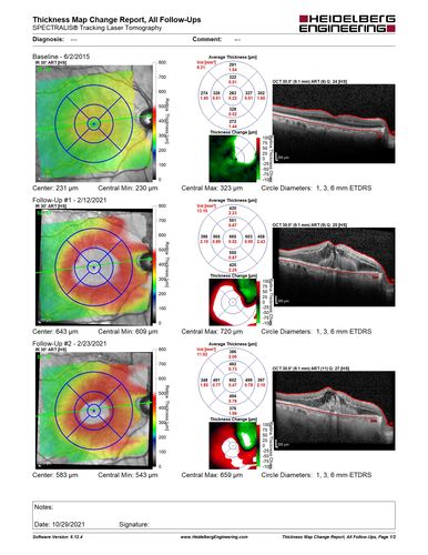 Old BRVO with venous MA - post-laser OCT Maps
