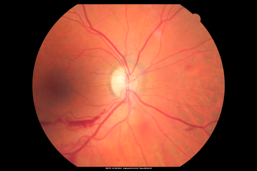 Branch Retinal Vein Occlusion with NVE (Neovascularization Elsewhere)
