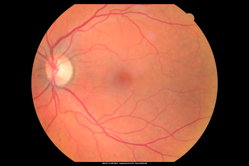 Branch Retinal Vein Occlusion with NVE (Neovascularization Elsewhere)
