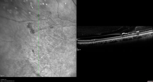 Branch Retinal Vein Occlusion with NVE (Neovascularization Elsewhere)
SD-OCT of NVE - shows it to be pre-retinal
