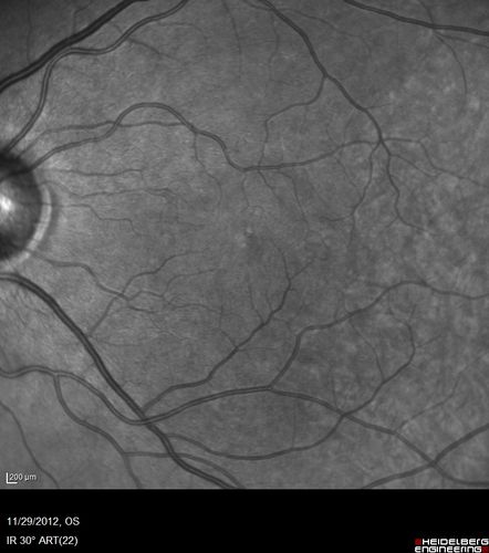 Branch Retinal Vein Occlusion with NVE (Neovascularization Elsewhere)

