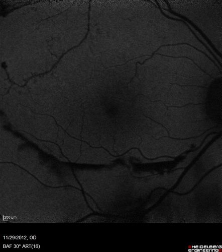 Branch Retinal Vein Occlusion with NVE (Neovascularization Elsewhere)
