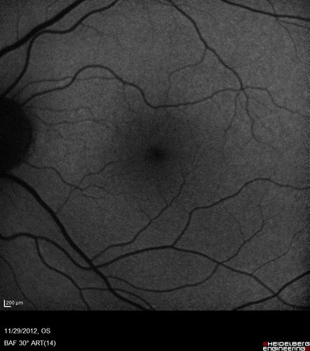 Branch Retinal Vein Occlusion with NVE (Neovascularization Elsewhere)
