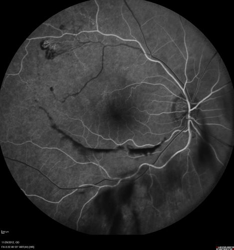 Branch Retinal Vein Occlusion with NVE (Neovascularization Elsewhere)
