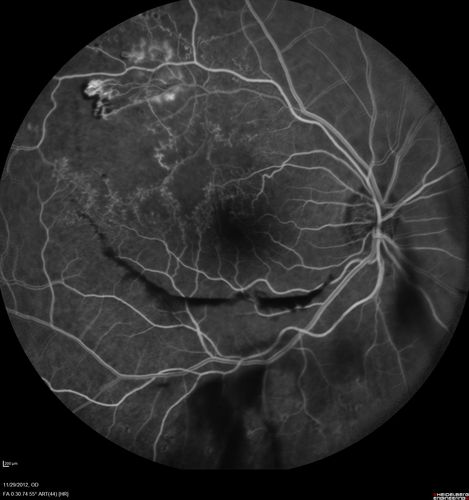 Branch Retinal Vein Occlusion with NVE (Neovascularization Elsewhere)
Late Leakage on FA - NV is adjacent to non-perfusion
