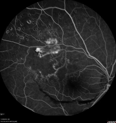 Branch Retinal Vein Occlusion with NVE (Neovascularization Elsewhere)
Late Leakage on FA - NV is adjacent to non-perfusion
