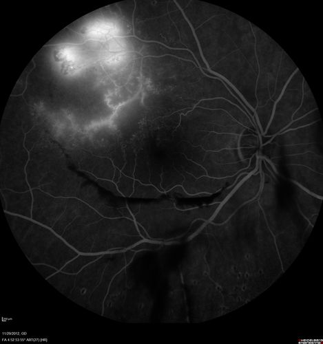 Late Leakage on FA
Keywords: Branch Retinal Vein Occlusion with NVE (Neovascularization Elsewhere)