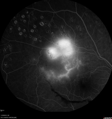 Branch Retinal Vein Occlusion with NVE (Neovascularization Elsewhere)
Late Leakage on FA
