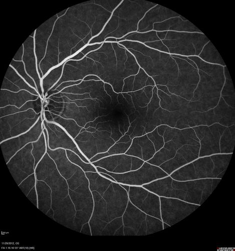 Branch Retinal Vein Occlusion with NVE (Neovascularization Elsewhere)
