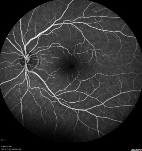 Branch Retinal Vein Occlusion with NVE (Neovascularization Elsewhere)
