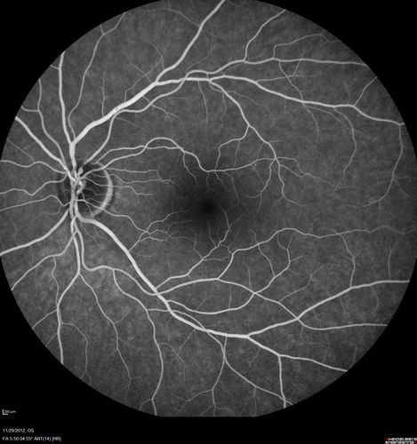 Branch Retinal Vein Occlusion with NVE (Neovascularization Elsewhere)
