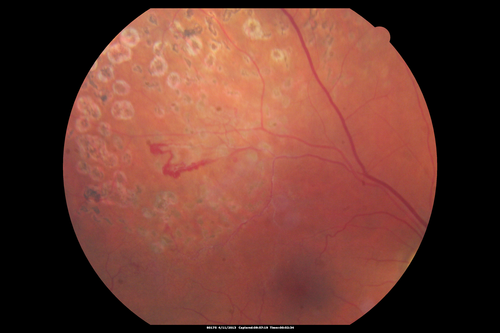 Branch Retinal Vein Occlusion with NVE (Neovascularization Elsewhere)

