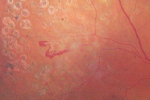 Branch Retinal Vein Occlusion with NVE (Neovascularization Elsewhere)
One month post laser
