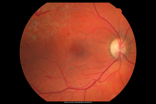 Branch Retinal Vein Occlusion with NVE (Neovascularization Elsewhere)
