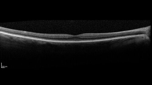 BRVO with good vision
87 year old man with good vision (diabetes without retinopathy).  VA 20/25 OU.  Vision never worsened from BRVO OS.
