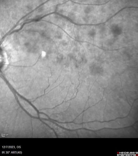 BRVO with good vision
87 year old man with good vision (diabetes without retinopathy).  VA 20/25 OU.  Vision never worsened from BRVO OS.
